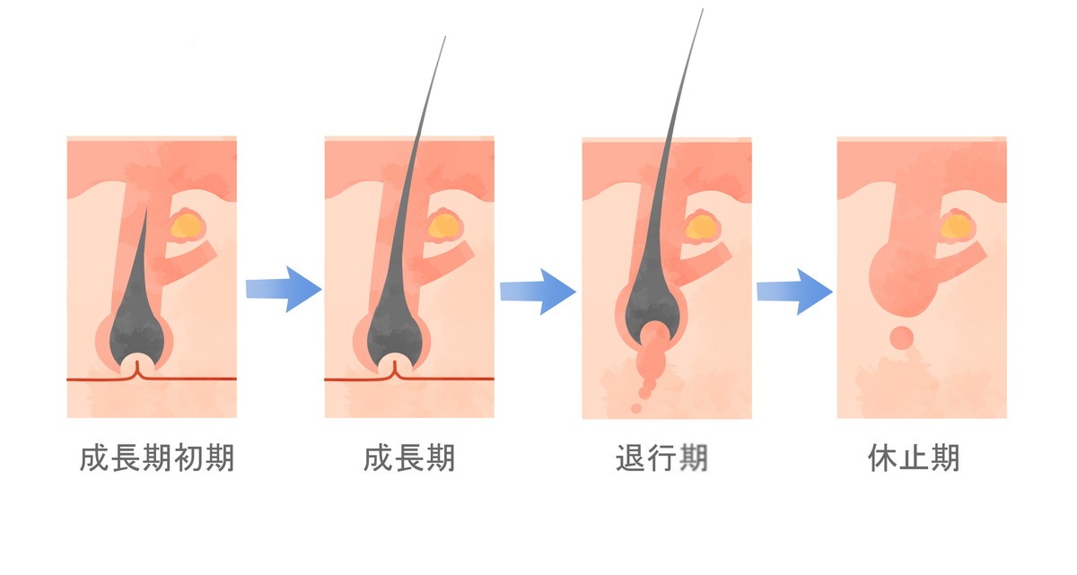 レーザー治療