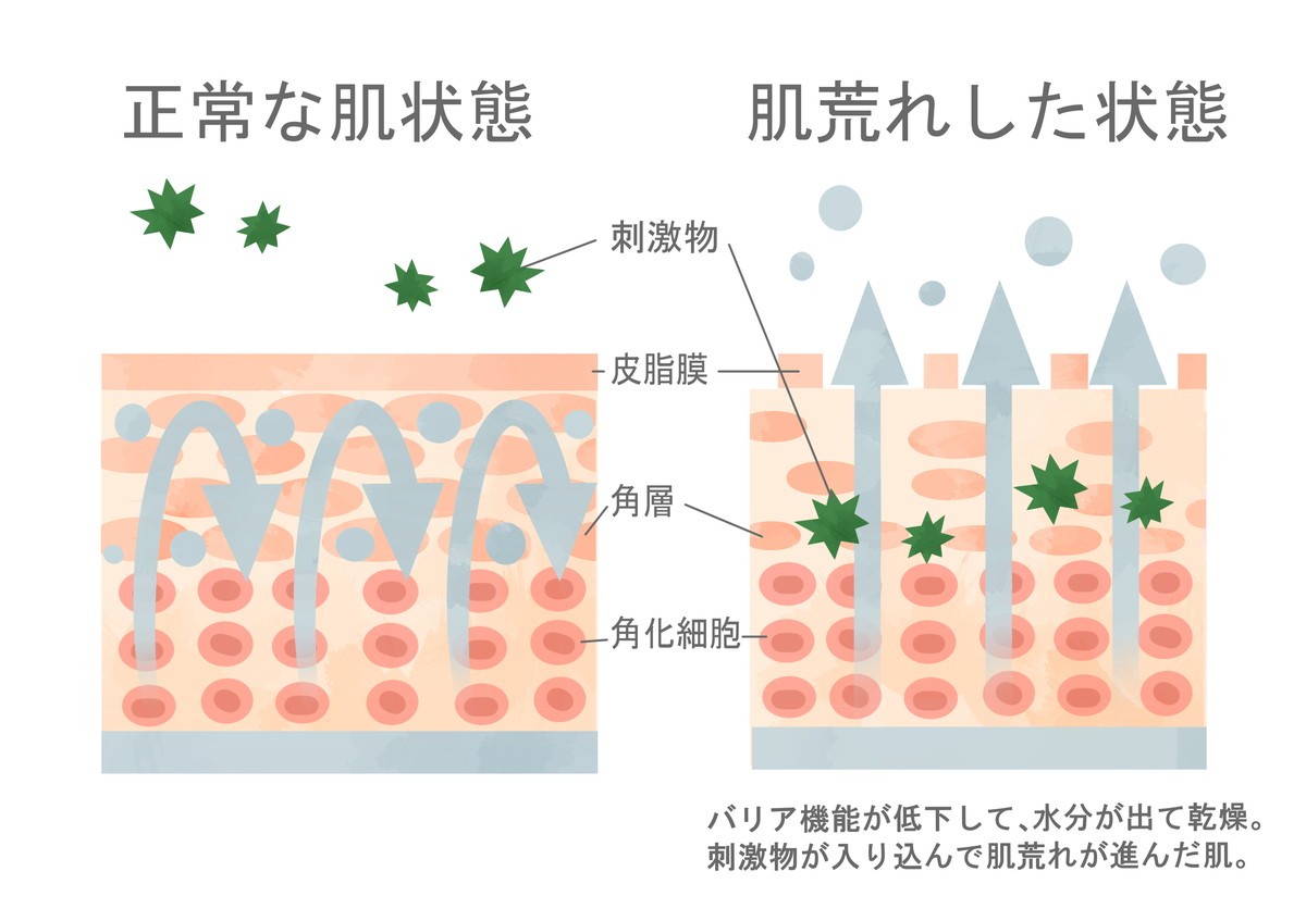 レーザー治療