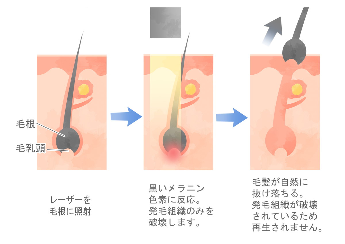 レーザー治療