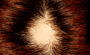 円形脱毛症の治療 女性薄毛治療 中央クリニック