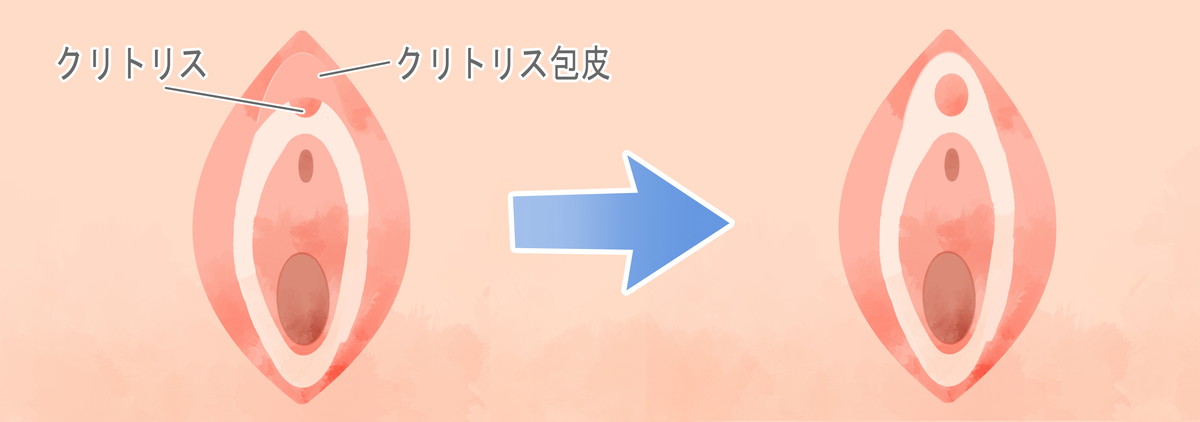 クリトリス包茎治療 美容外科 美容皮膚科なら中央クリニック