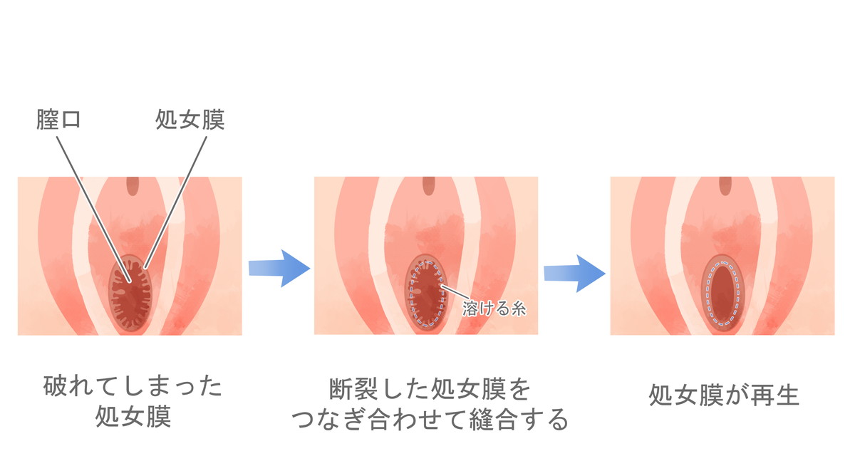 処女膜 処女膜再生・形成｜初体験のドキドキを！処女膜を再現する婦人科 ...