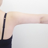体験談 二の腕の脂肪溶解注射 美容外科 美容皮膚科なら中央クリニック 体験談 二の腕の脂肪溶解注射 美容外科 美容皮膚科なら中央クリニック