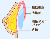 fig-bustup-02