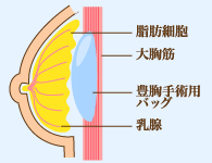 fig-bustup-03