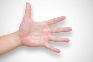 【手掌多汗症】 治療の必要レベルはドコ? 私の手汗問題と対策
